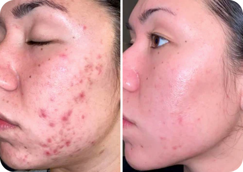 Rosacea Corrector