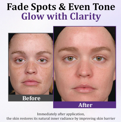 Lovilds Epiglow Melanev Advanced Anti Pigmentation Cream