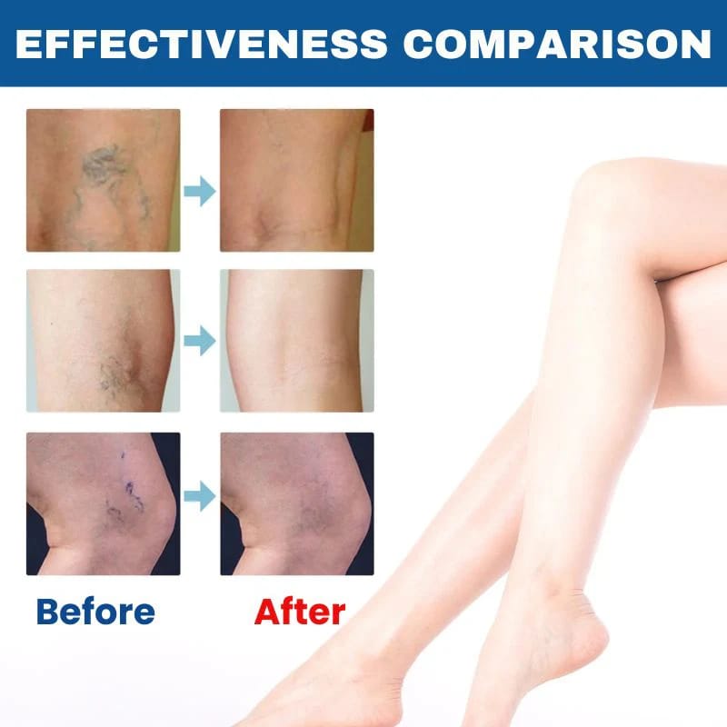 BARUBT Varicose Vein Solution Spray | Reduce Leg Pain and Swelling by 90% – Eliminate Varicose Veins in 2 Weeks!