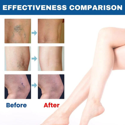 BARUBT Varicose Vein Solution Spray | Reduce Leg Pain and Swelling by 90% – Eliminate Varicose Veins in 2 Weeks!