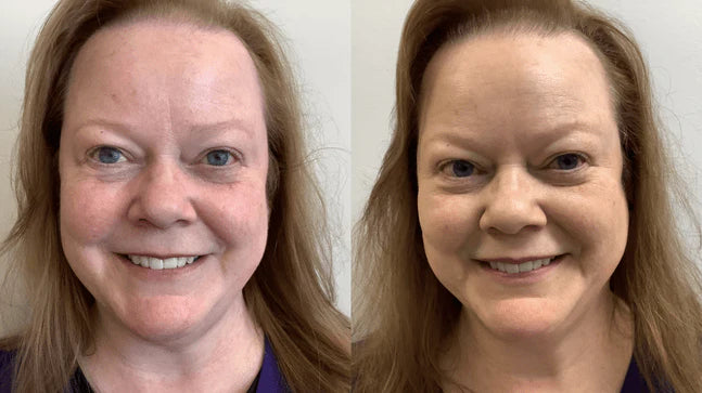 Rosacea Corrector