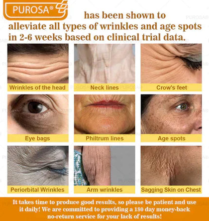 🐝PUROSA® Bee Venom Skin Treatment Cream, Anti-aging, Hydrating, Skin Repair, Even Tone, Acne and Dark Spot Treatment, Wart and Mole Removal, Psoriasis Relief