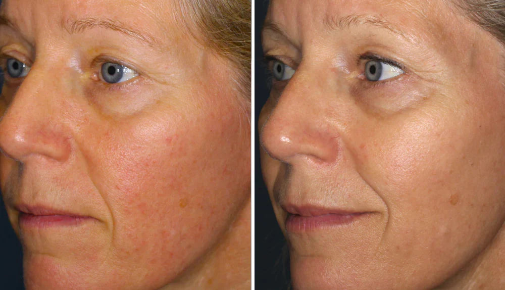 Rosacea Corrector