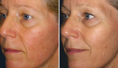 Rosacea Corrector